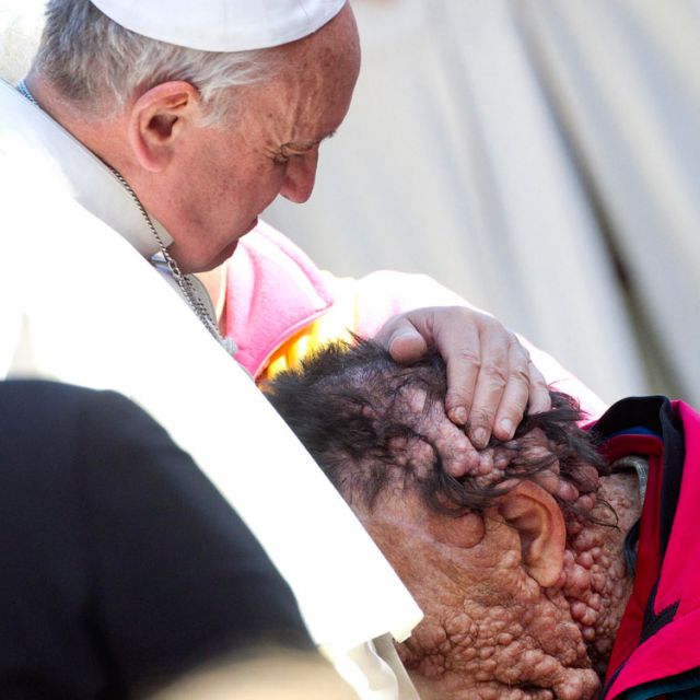 Pope's embrace was heavenly, says man with disfiguring disease 